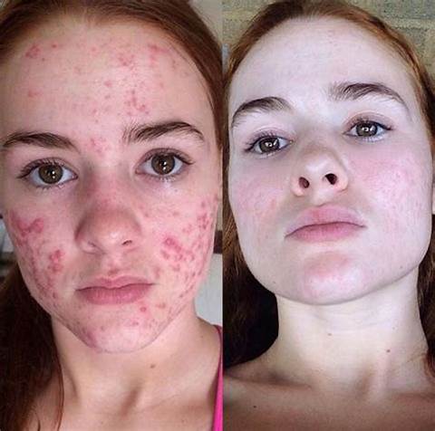 ❤️Advacnced Scar Spray For All Types of Scars- For Example Acne Scars, Surgical Scars and Stretch Marks⚡⚡⚡
